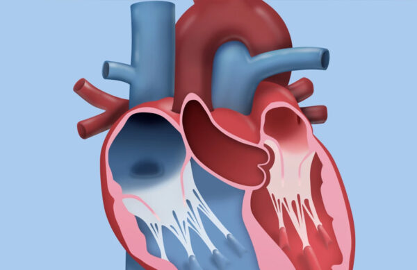 Prolapso Da V Lvula Mitral Centro De Cardiologia